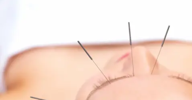 Cosmetic Acupuncture